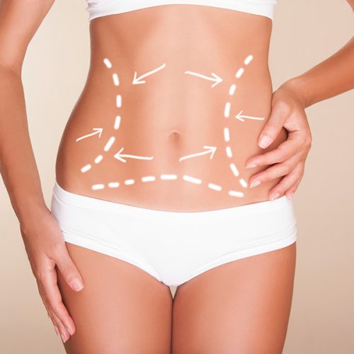 abdominoplastia-porto-alegre-rubem-lang
